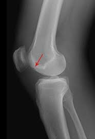 The anterior cruciate ligament (acl) and the posterior cruciate ligament (pcl) are inside the knee joint. Acl Tear Knee Sports Orthobullets