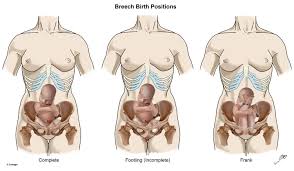 Breech Presentation Obstetrics Medbullets Step 2 3