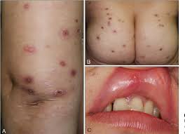 Image result for Pathergy