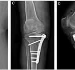 Frontiers | Novel anatomically contoured locking plate shows ...