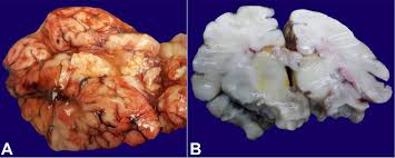 Image result for Kernicterus