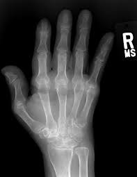 Image result for XRay Changes in Rheumatic Conditions