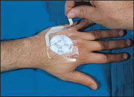 Image result for LET Anesthesia