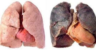 Pulmón de persona no fumadora vs pulmón de persona fumadora . 🚭🤢😷 . # pulmones #pulmon #sano #enfermo #nofumar #nofumen #feo #adictivo #legal  #veneno #epoc #neumonologia #pneumonology #aparatorespiratorio #medicina  #anatomia #anatomy #biologiahumana ...