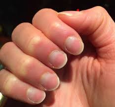 nail abnormalities causes symptoms and pictures