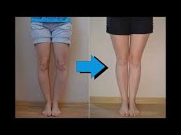 5 Exercises To Correct Bow Legs Biutidiy Bow Legged Correction Bow Legged Knock Knees