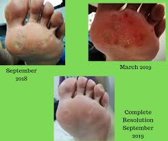 Apply the paste directly on the wart and cover with a bandaid. Make Your 2020 Resolution To See A Podiatrist West Berkshire Foot Clinic