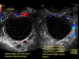 Image result for corpus luteum sonography)