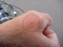 Image result for große winkelspinne biss haut reaktion