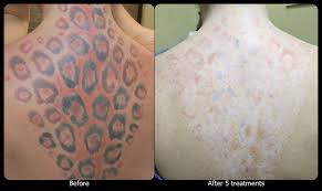 We cover the number of sessions needed to the speed of tattoo removal in this post. Black Ink Tattoo Removal