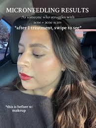 This is after just 1 treatment! I will be doing a total of 3 treatment...