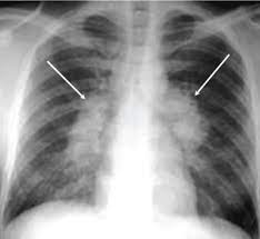 Tb disease is treated by taking several drugs as recommended by a health care provider. The Radiological Diagnosis Of Pulmonary Tuberculosis Tb In Primary Care