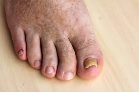 Symptoms a foot infection may make it difficult to walk. What Are Toe Infection And How To Treat Them Marietta Foot Doctor