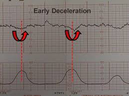 Electronic Fetal Monitoring Fetal Heart Monitoring Fetal Monitoring Ob Nursing