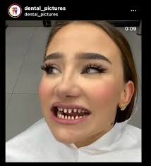 Veneers with translucent appearance, affordable options?