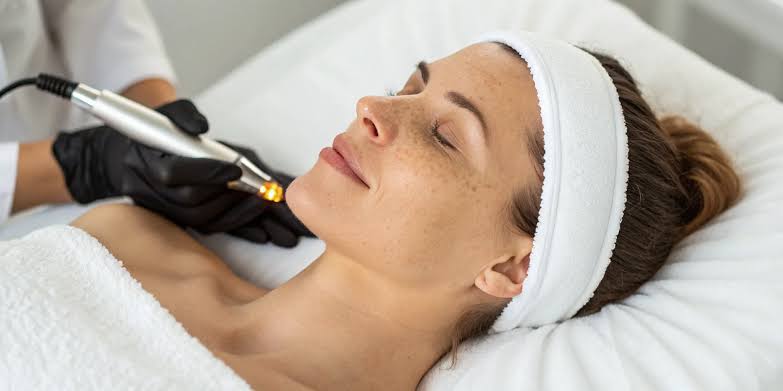Using IPL for Sun Damage: Your Complete Guide