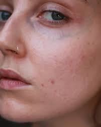 7 Acne Positive Influencers You Should Follow ASAP