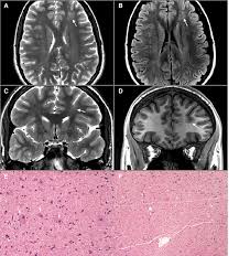 A multiparametric mri is a combination of two or more sequences. Mri And Pathologic Findings From A 21 Year Old Patient With Etle Axial Download Scientific Diagram