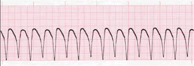 Click the link below to get free access to a massive library of helpful videos. Ventricular Rhythms Ventricular Tachycardia Ventricular Tachycardia Ekg Interpretation Ekg Strips