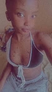 Faces of Neurofibromatosis