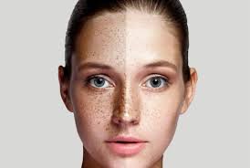 Image result for Melasma