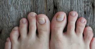 Image result for Paronychia feet