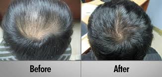 Heredity accounts for 95% of all the cases of alopecia (baldness) for men and women in this country. Professional Laser Hair Therapy Clinically Proven 90 Effective
