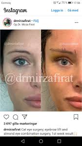An eye holder gently keeps the lid open during the procedure to prevent blinking. Pin By Eylul Naz On Badem Goz Brow Lift Surgery Eye Lift Surgery Facial Fillers