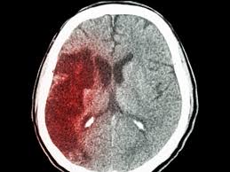 La muerte encefálica es el cese irreversible en las funciones de todas las estructuras neurológicas intracraneales tanto de los hemisferios cerebrales como de tronco encefálico. Neurologos Solicitan Crear Protocolos Uniformes Para Declarar Muerte Cerebral