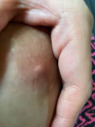 What is this on my breast areola? | BabyCenter