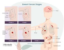 Image result for Breast Cancer Staging