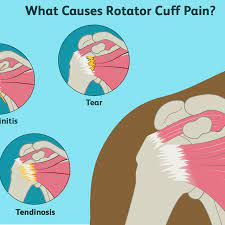 Rotator Cuff Pain: Treatment, Symptoms, Causes, And More