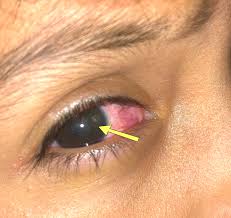 Image result for Eye Foreign Body