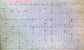 La forma más frecuente es la. Miocarditis Rm Sociedad Espanola De Cardiologia