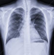 Image result for Chest XRay