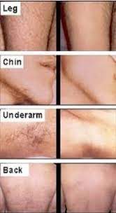 It then shocks and damages the follicle by heating it up, which reduces the appearance of hair and can stop. Laser Hair Removal Louisville Ky Physician S Center For Beauty