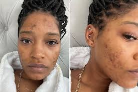 Robert palmer — bad case of loving you (doctor, doctor) (20th century masters: Keke Palmer On Polycystic Ovarian Syndrome Acne Struggles