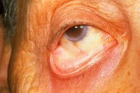 Image result for Anemia angolensis