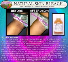 15 Before And After Pics Natural Skin Bleach Devotedthings Skin Bleaching Skin Bleaching Cream Natural Skin Lightening