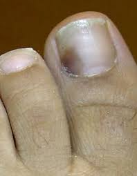 Avoid removing cuticles firmly from the nail and do not clean the nails very deeply since it may cause infection. Nail Disease Wikipedia