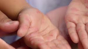 Measles reported in new Wisconsin location, with total cases nearing 170