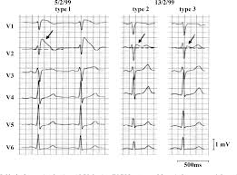 Figure 1 From Diagnosis And Management Of Brugada Syndrome Semantic Scholar