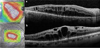 Jun 24, 2021 · x retinopathy of prematurity (rop) screening, an integral part of pediatric ophthalmology, can be time consuming and resource intensive. Macular Edema After Rhegmatogenous Retinal Detachment Repair Risk Factors Oct Analysis And Treatment Responses International Journal Of Retina And Vitreous Full Text