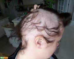 When hair loss happens, shock and disappointment can be overwhelming. Stop Childhood Hair Loss Due To Tinea Capitis Vs Alopecia Areata Vs Trauma Or Traction Damage And 1 More Visihow