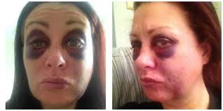 Woman takes domestic violence selfies to show healing face.