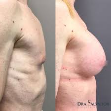 Operación de hombre a mujer: antes y después - Doctora Salvador