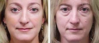 Blefaroplastia Antes E Depois Cirurgia De Palpebras Blefaroplastia Cirurgia Palpebras