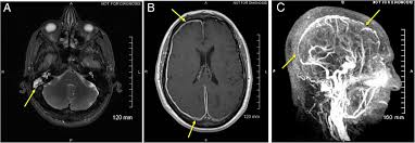 What causes cerebral venous sinus thrombosis? Cerebral Venous Sinus Thrombosis Secondary To Otomastoiditis Postgraduate Medical Journal