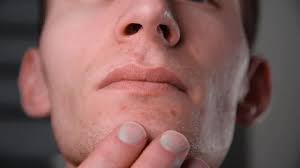 Acne Stock Footage Royalty Free Stock Videos Pond5 Happy caucasian boy with acne skin using hands as a mask. acne stock footage royalty free stock