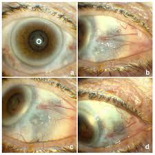 Image result for lesion sclera